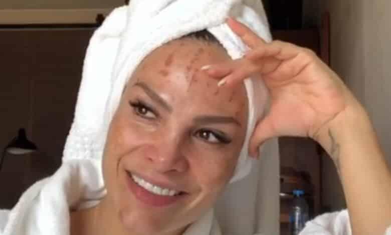 Campomanes muestra lesiones en su rostro Campomanes muestra lesiones en su rostro