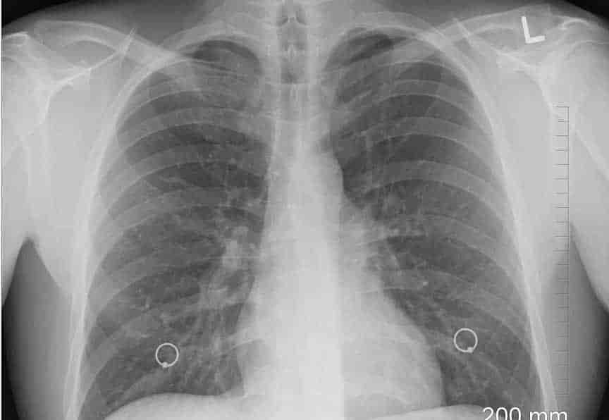 Covid-19 daña más a los pulmones que el cigarro: experta