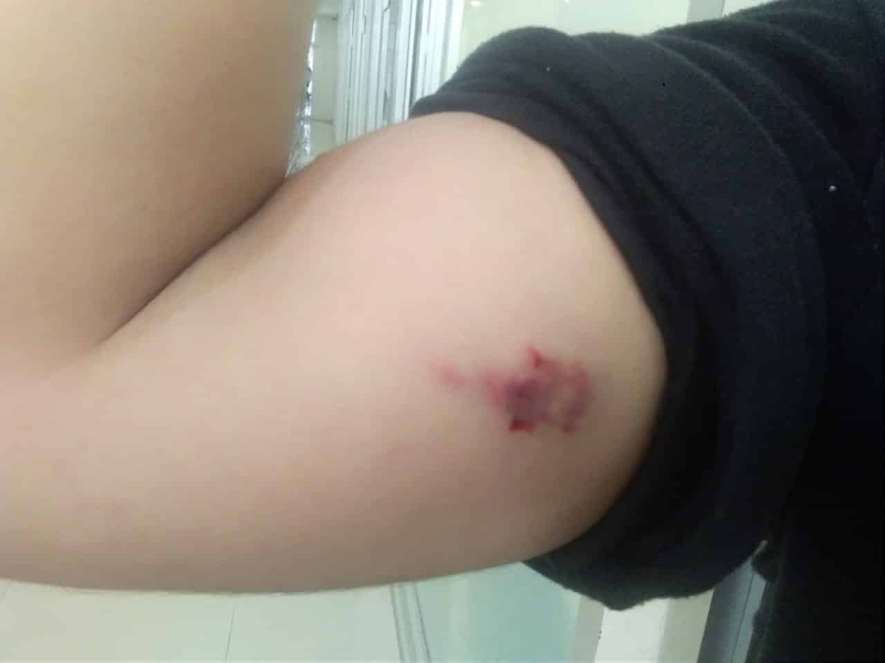 El ladrón de domicilios atacó a mordidas a los uniformados