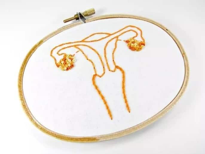 IA para detectar precursores del cáncer de cuello uterino