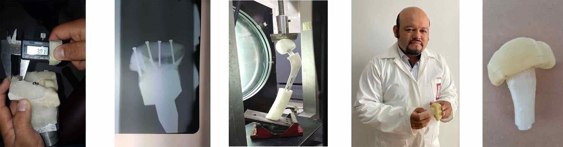 Desarrolla IPN prótesis de cadera única en su tipo Desarrolla IPN prótesis de cadera única en su tipo