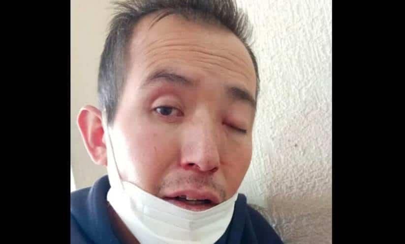 Fallece paciente con síntomas de hongo negro Fallece paciente con síntomas de hongo negro