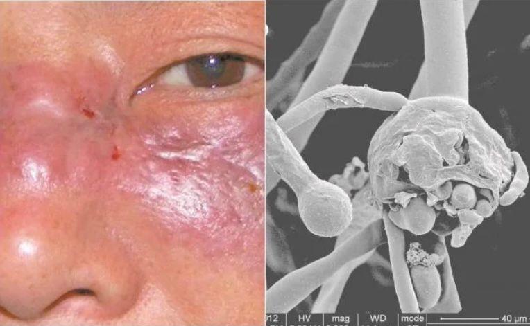 Fallece paciente por hongo negro Fallece paciente por hongo negro