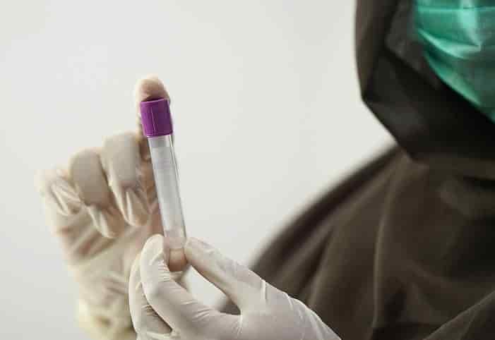 Guinea confirma caso de la enfermedad por virus de Marburgo