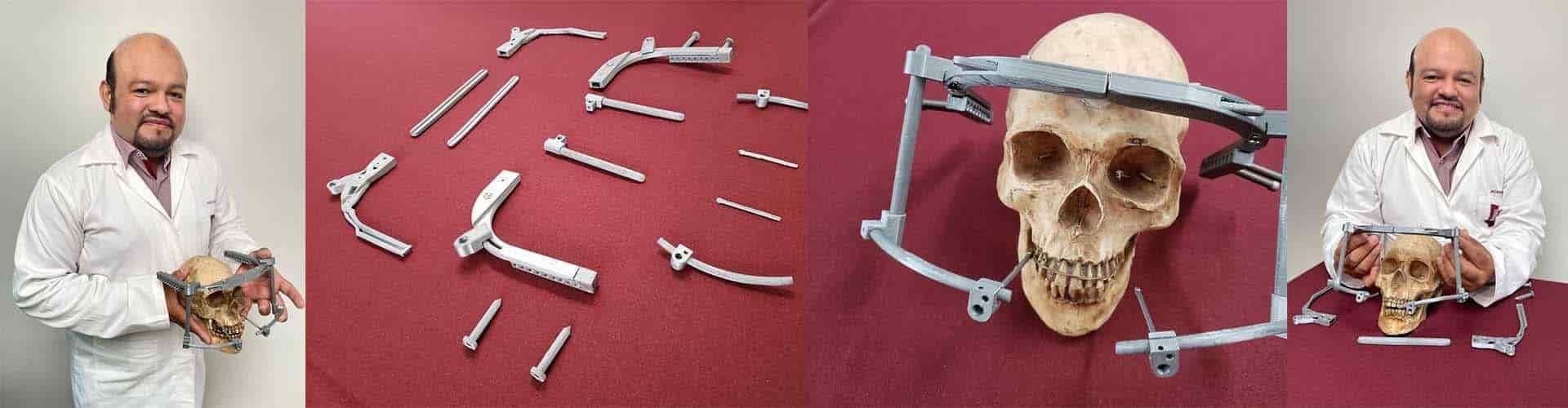 Corregirán deformaciones craneales con impresion 3D