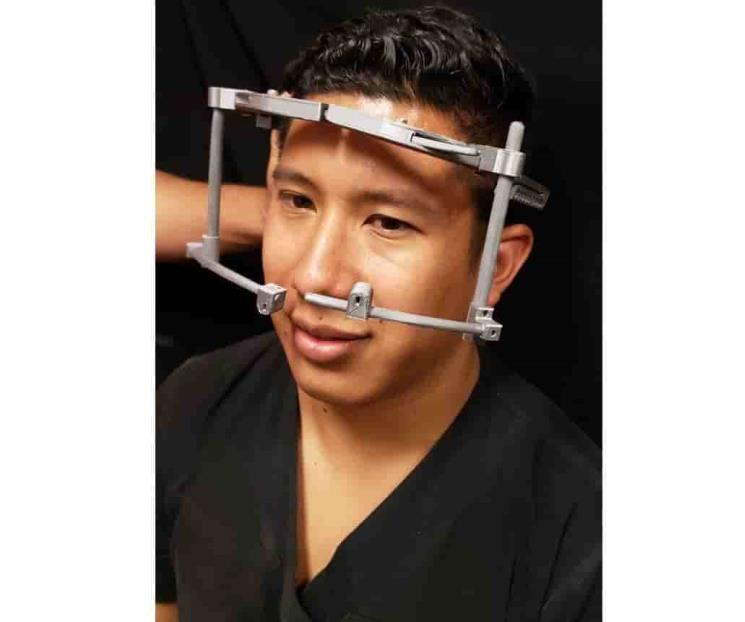 Crean en IPN dispositivo para tratar deformaciones craneales