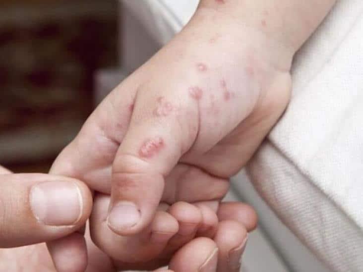 Reportan que 90 niños se infectaron con coxsackie en Perú
