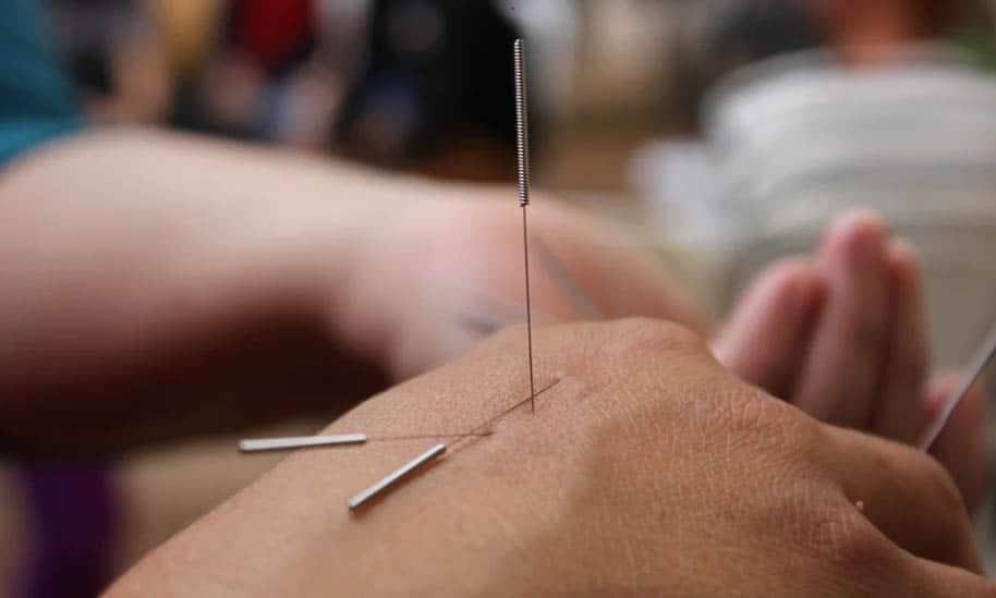 ¿La acupuntura miente?