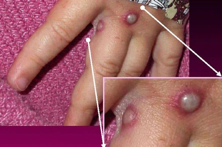 Virus del mono y hepatitis infantil, qué sabemos de estas