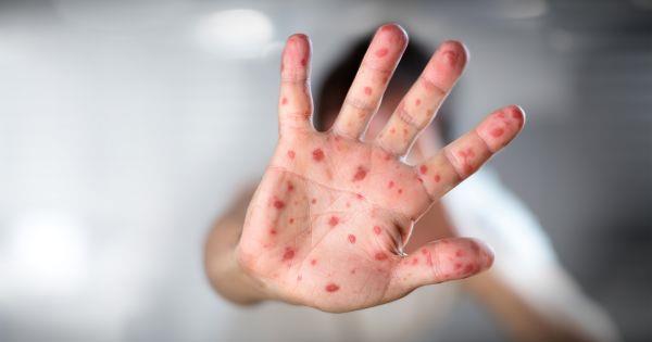 Emiten alerta para detectar casos de viruela del mono