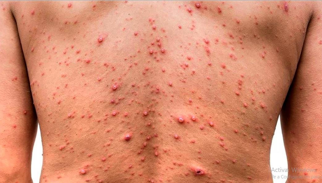 Reportan al menos 80 países casos de viruela símica