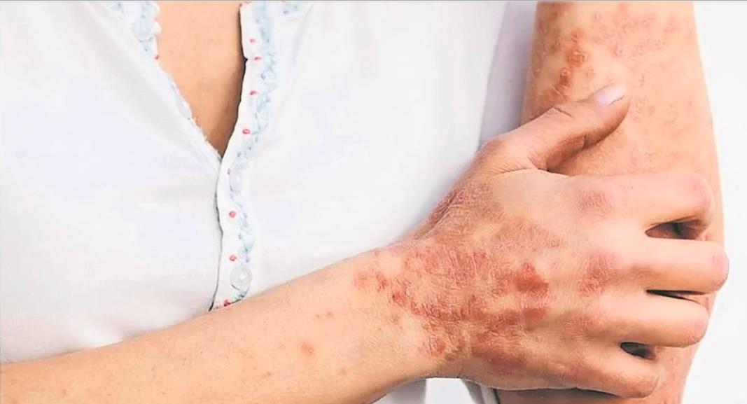 FDA aprueba vacuna JYNNEOS contra viruela del mono en EU