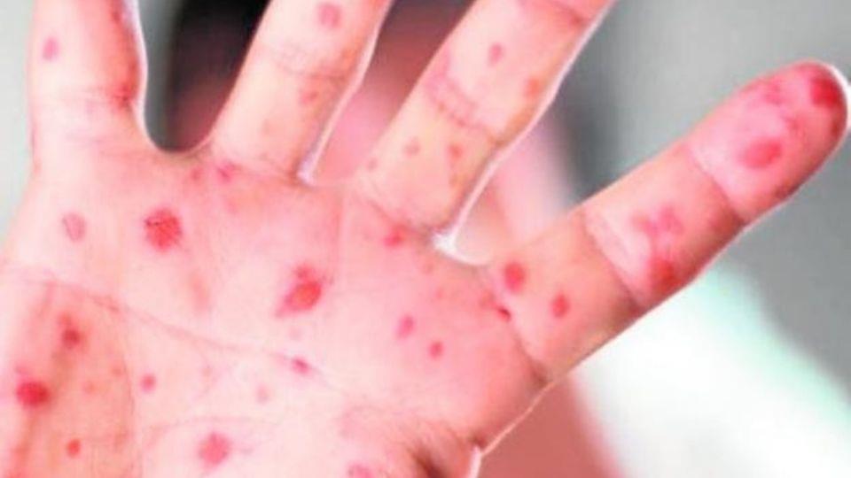 ¿Qué es la gripe del tomate?