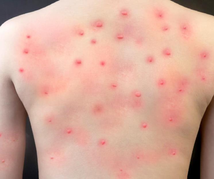 Reporta SS tres casos más de viruela símica Reporta SS tres casos más de viruela símica