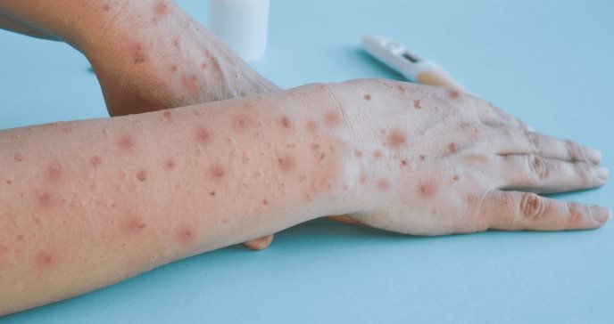 Harán ensayo en 500 voluntarios, con Tecovirimat Harán ensayo en 500 voluntarios, con Tecovirimat