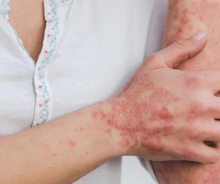 México tiene 504 contagios de viruela del mono México tiene 504 contagios de viruela del mono