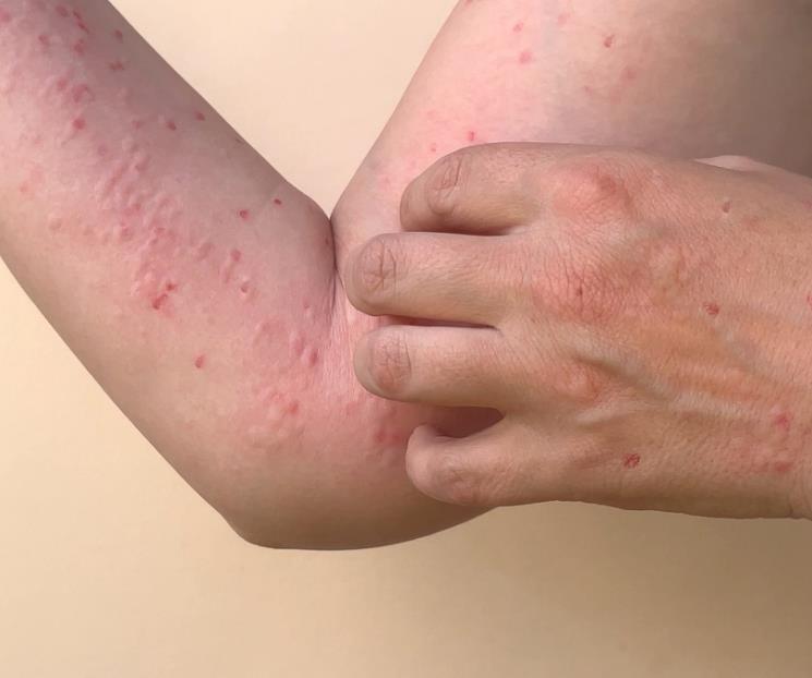 Ya son  50 mil casos de viruela del mono a nivel mundial