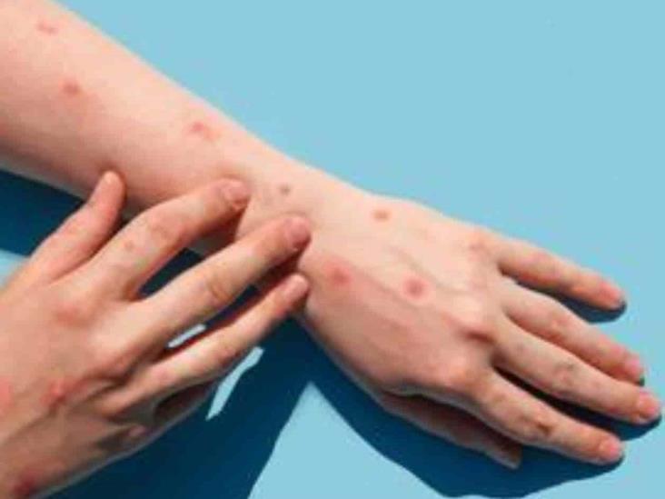 Viruela del mono rebasa los mil casos confirmados