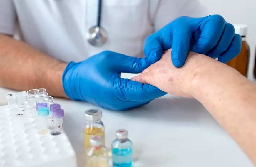 México suma mil 367 contagios de viruela del mono México suma mil 367 contagios de viruela del mono