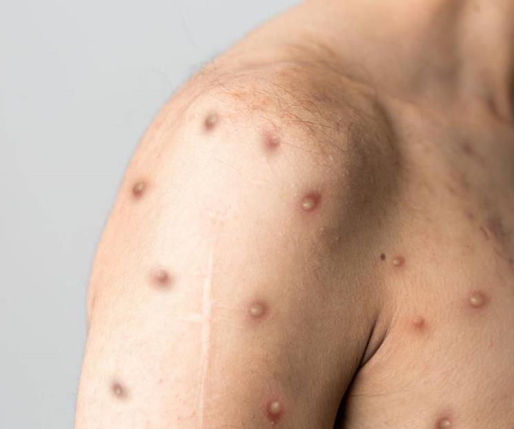 México registra 2 mil 147 casos de viruela del mono