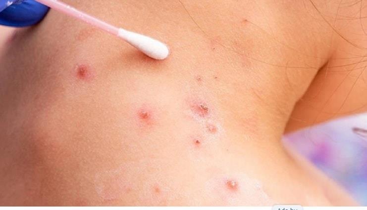 Exigen vacuna contra viruela del mono