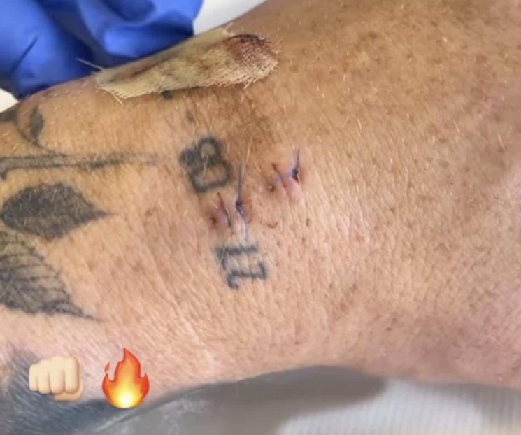Tiene Canelo clara mejoría post cirugía en mano izquierda
