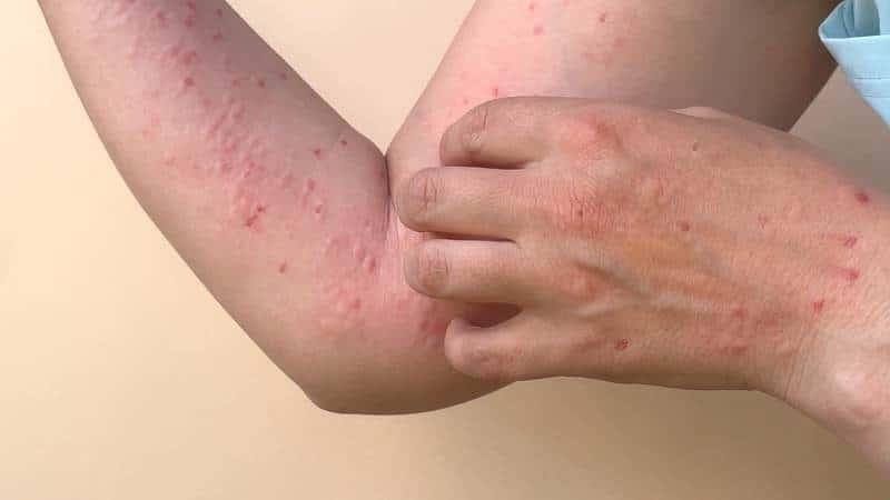 México suma tres mil 362 casos de viruela del mono