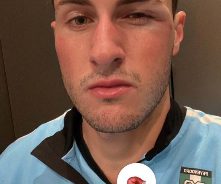 Sufre Santi Giménez golpe fuerte en el rostro Sufre Santi Giménez golpe fuerte en el rostro