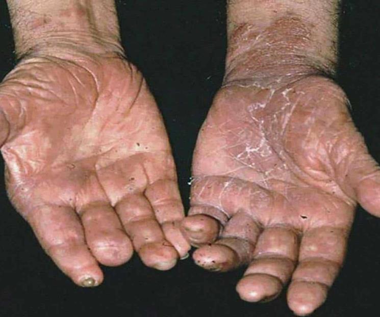 La lepra, una enfermedad que no ha sido derrotada La lepra, una enfermedad que no ha sido derrotada