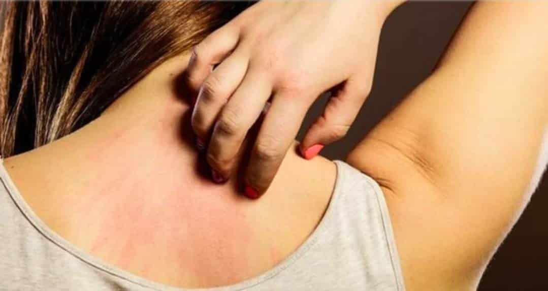 Pensó que era alergia al jabón Pensó que era alergia al jabón