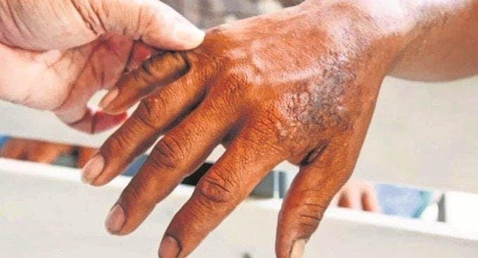 Secretaría de Salud vigila 12 municipios por casos de Lepra