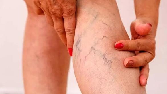 La forma de aplicar aceite de oliva para combatir várices