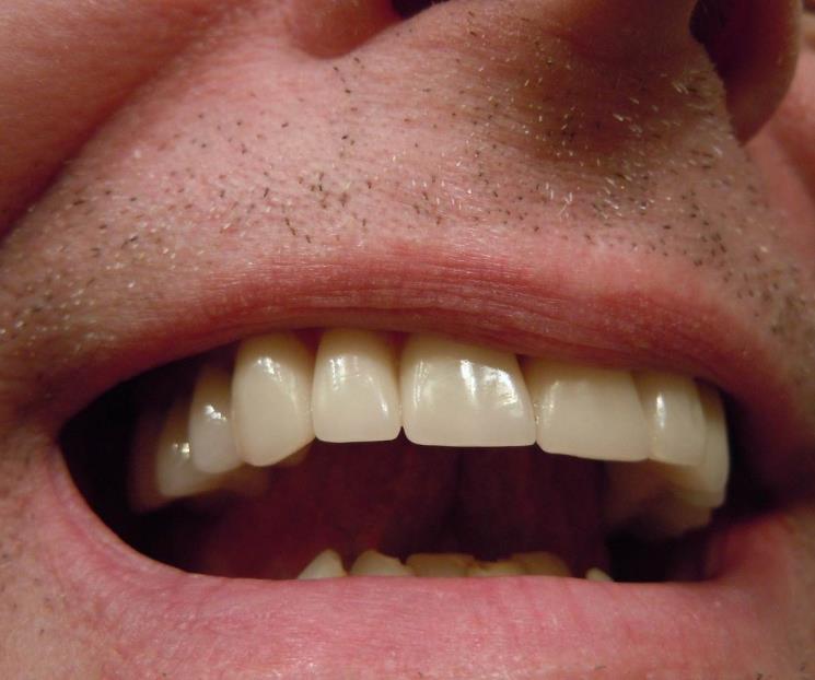 Halitosis, enfermedad que produce el mal aliento excesivo Halitosis, enfermedad que produce el mal aliento excesivo