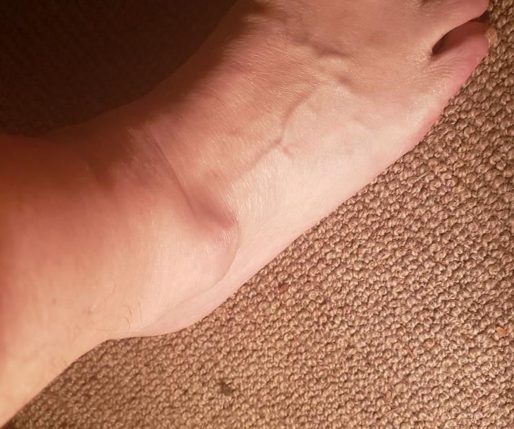 Así puedes desinflamar un tobillo hinchado