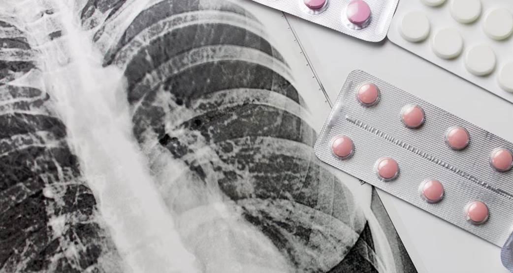 Detectan casos de tuberculosis en migrantes de Chicago