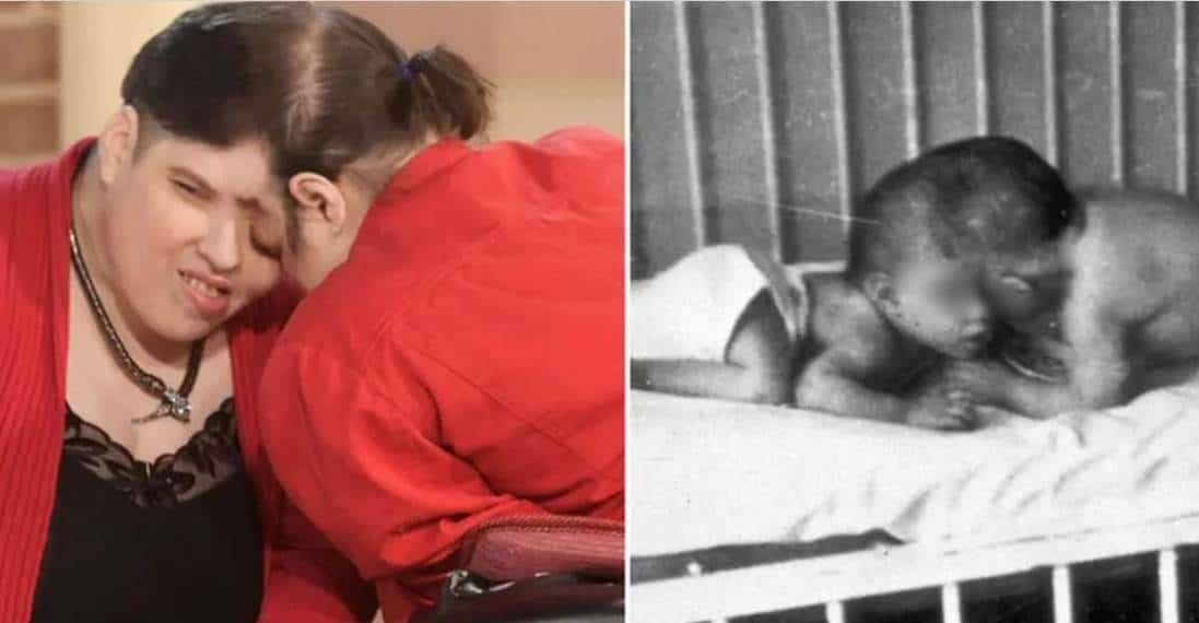 Mueren Lori y George Schappell, los gemelos siameses más longevos