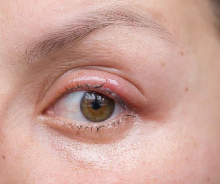 El remedio casero que quita los orzuelos y calma el dolor