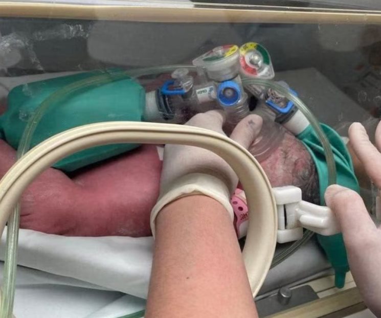 Una de las bebés siamesas separadas en Nuevo León es dada de alta
