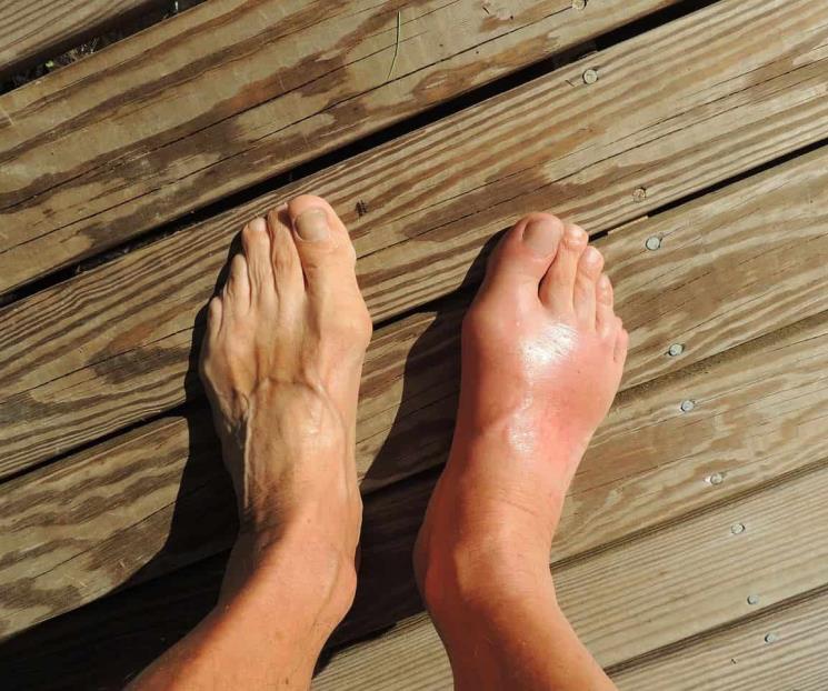 Termina con los edemas en tobillos, pies y piernas con este remedio