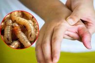 Reportan 33 casos de miasis por gusano barrenador