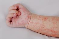 Sube a 17 las muertes por sarampión en Chihuahua