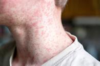 Lidera México muertes por sarampión en el continente Lidera México muertes por sarampión en el continente