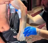 Un cocinero de un restaurante de carnes asadas ubicado en el centro de la ciudad, terminó con diversas quemaduras al caerle encima una olla con agua hirviendo.