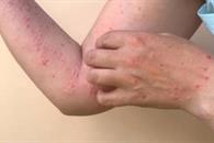 Salud reporta 74 casos de sarampión activos en nueve estados