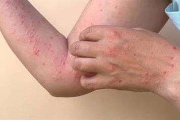 Salud reporta 74 casos de sarampión activos en nueve estados