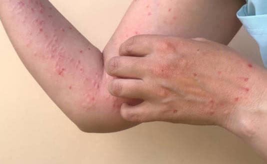 Salud reporta 74 casos de sarampión activos en nueve estados