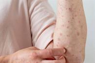 Piden informar sobre la prevención del sarampión