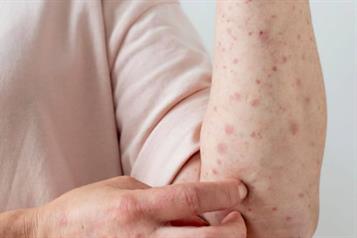 Piden informar sobre la prevención del sarampión