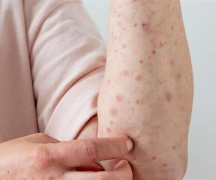 Piden informar sobre la prevención del sarampión