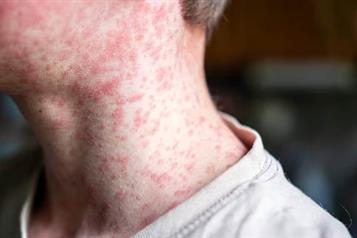 Activan aviso epidemiol&oacute;gico tras 45 casos de sarampi&oacute;n en Chiapas